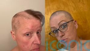 Teacher with trichotillomania who spent hours a day pulling hairs now embracing new look as ‘bald, beautiful woman’