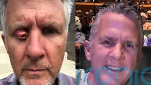 Dad at risk of losing sight after cancerous eyelid tumour swelled to ‘size of cherry tomato’ praises Specsavers and NHS