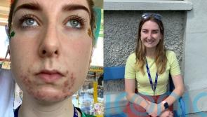 Teacher whose ‘beard of spots’ from wearing Covid masks sent ‘shiver down the spine’ of her pupils finds AI solution