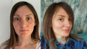 Mum who fled Ukraine with daughter says it ‘aged her many years’ but lip and cheek fillers are helping her move forward