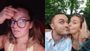 Woman with ‘terrible’ acne who feared she would never find love now in happy relationship and has found AI skin solution
