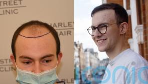 Student who struggled with depression due to receding hairline aged 16 feels he can ‘do anything’ after hair transplant