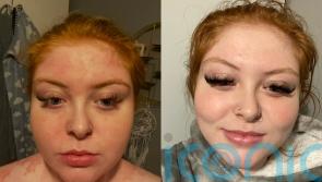 Woman who developed psoriasis all over her body due to trauma of being sexually abused has found a ‘miracle’ cure