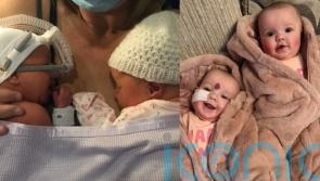 Mum who turned down abortion for twin daughter celebrates tot’s remarkable recovery after major surgery a few hours old