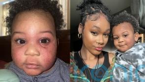 Baby who itched until he ‘bled all over the bed’ due to steroid withdrawal and severe eczema cured by high street cream