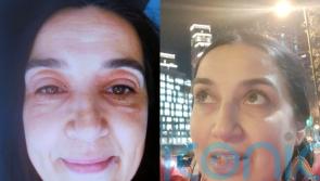 Woman who looked like a ‘toad’ due to severe eye eczema brought on by menopause cured by miracle eye gel