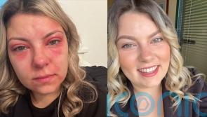 Mum who became a recluse after allergic reaction led to sore and flaky skin says cream ‘helped me get my life back’
