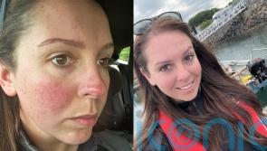 Mum whose ‘awful’ skin condition ‘put a downer’ on her pregnancy finds ‘miracle cure’ after bursting into tears in car