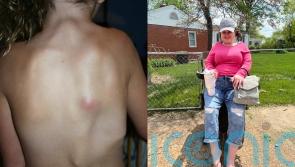 Blogger who is ‘growing second skeleton’ and can’t walk due to rare disorder hopes to start family and go swimming again