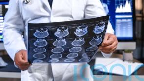 New drug found to slow Alzheimer’s hailed as turning point