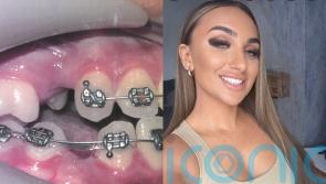 Student awarded £22,000 by dentists after two wrong teeth extracted and untreated decay led to loss of third tooth at 15