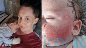 Mum of seven whose baby was born with skin ‘like a snake’ finds ‘miracle’ cream for son’s sore and peeling skin