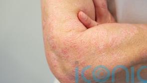 Psoriasis Awareness Month: Everything you need to know