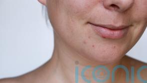 How can you get rid of acne scars? From serums to laser treatments, experts talk through the options