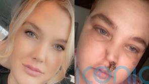 Mum pulling lumps of cartilage from nose afraid to show face in public after rare condition mistaken as infection