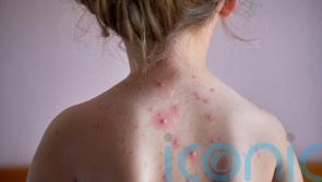 What parents need to know about chickenpox and the vaccine that could soon be on the NHS