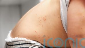 Childhood chickenpox vaccine recommended for use on the NHS