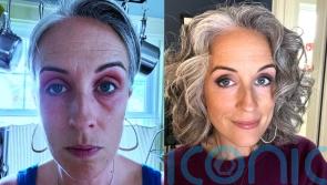 Hairstylist who spent all day apologising for painful red and swollen eyes finds flare-ups were caused by perimenopause