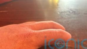 McCain Foods fined £700,000 over worker who had fingers amputated after accident