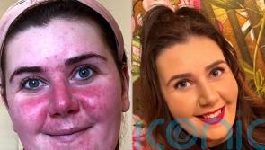Mum who developed rosacea after giving birth, forcing her to avoid family photos and dread leaving house, finds cure