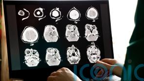 Longer term impact of sport-related brain injuries revealed by study