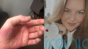 New mum whose psoriasis meant she could not change baby’s nappy and lost four fingernails feels ‘amazing’ thanks to cure