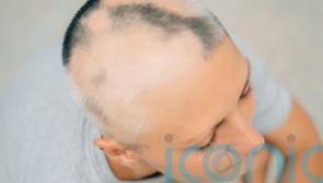 First alopecia treatment approved for NHS use