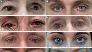Researchers able to make better artificial eyes using 3D printing – study