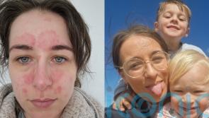 Mum battling psoriasis since school who faced staring and severe post-pregnancy flare up finds ‘life changing’ cure