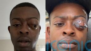 Man whose eye was ‘protruding from head’ says he visited hospitals nine times before cancer diagnosis