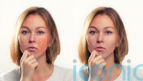 Could your flushed skin be rosacea? Experts highlight the early signs and symptoms