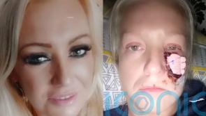 Single mum mauled by friend’s sausage dog which ripped large chunk of cheek off before eating it in front of her