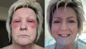 Mum who felt like monster after waking with red rings around her eyes that burned like acid finds ‘godsend’ cure