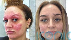 Mum whose face was suddenly ‘sunburnt’ by acne after having first child finds ‘miracle’ cure after six years of pain