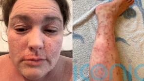 ‘My extreme eczema cost me a job and made me a recluse but sharing my skin on social media makes me more confident’