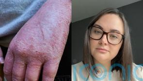 Mum whose hands resembled ‘raw red meat’ due to psoriasis could not wear wedding ring until she found £11 ‘magic’ cream