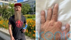 Carpenter who sawed off two digits on hand in work accident has ‘second chance’ at career after toe-to-thumb transplant