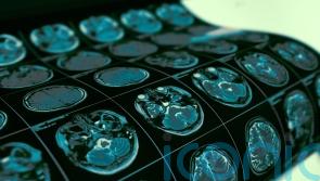 Top cancer charities to open brain tumour research centre in Scotland