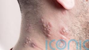 Shingles vaccine ‘cuts dementia risk by 17%’ – what is shingles and how does the vaccine work?