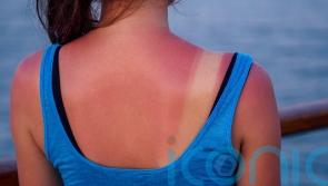 How to soothe painful sunburn