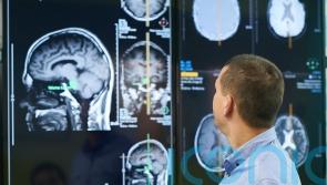 Experts analyse brain scans in bid to develop tool to predict dementia risk