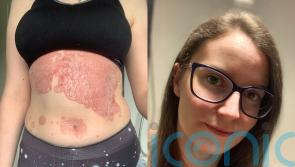 ‘My psoriasis was so bad I had to scoop and hoover flakes of my skin off the floor – a Facebook advert changed my life’