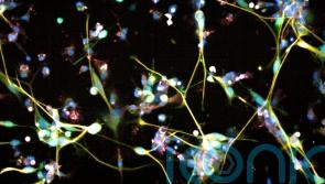 Common antidepressant ‘unexpectedly effective’ against aggressive brain tumours