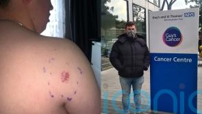 ‘Doctors thought itchy lump was ringworm or a tattoo allergy – it was cancer and I’ve paid £3k on travel for treatment’