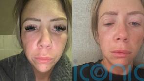 ‘I’m beautiful and I never needed it’: Mum’s facelift-gone-wrong forced her to postpone wedding and caused cancer scare