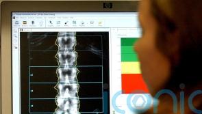Vitamin D supplements in pregnancy shown to improve bone density in childhood