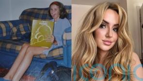 Mum with rare condition causing long limbs and hollow face has filler to ‘look normal’ after being called a ‘freak’