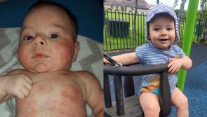 Mum whose baby looked like ‘burn victim’ with eczema says parents should trust ‘intuition’ and try natural products