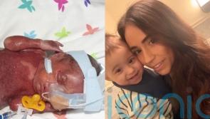 Baby who caught mother’s oral herpes in womb born three months early blind in one eye and looking ‘burnt all over’