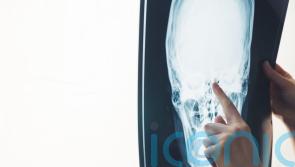 AI twice as accurate at pinpointing stroke time than current methods &ndash; study